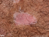 psoriasis_and_vitiligo