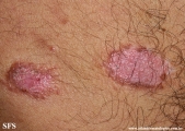 psoriasis_and_vitiligo