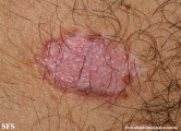 psoriasis_and_vitiligo