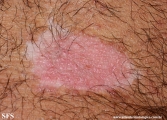 psoriasis_and_vitiligo