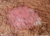 psoriasis_and_vitiligo