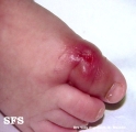 pyoderma gangrenosum