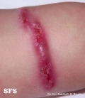 pyoderma gangrenosum