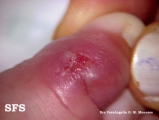 pyoderma gangrenosum