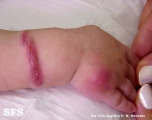 pyoderma gangrenosum
