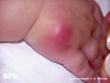 pyoderma gangrenosum