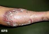 pyoderma gangrenosum