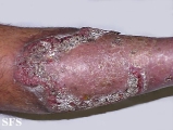 pyoderma gangrenosum