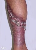 pyoderma gangrenosum