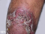 pyoderma gangrenosum