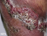 pyoderma gangrenosum