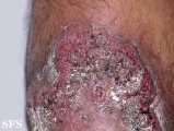 pyoderma gangrenosum