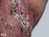 pyoderma gangrenosum