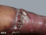 pyoderma gangrenosum