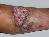 pyoderma gangrenosum