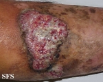 pyoderma gangrenosum