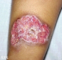 pyoderma gangrenosum