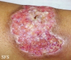 pyoderma gangrenosum