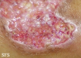 pyoderma gangrenosum