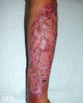 pyoderma gangrenosum