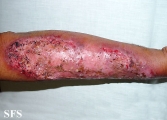 pyoderma gangrenosum