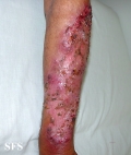 pyoderma gangrenosum