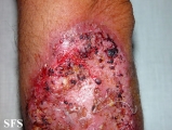 pyoderma gangrenosum