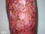 pyoderma gangrenosum
