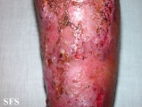pyoderma gangrenosum