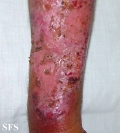 pyoderma gangrenosum