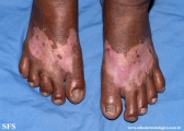 vitiligo-rubber_depigmention