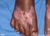 vitiligo-rubber_depigmention