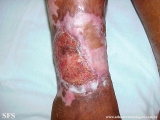 stasis ulcer