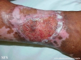 stasis ulcer