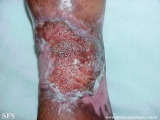 stasis ulcer