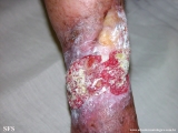 stasis ulcer