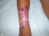 stasis ulcer
