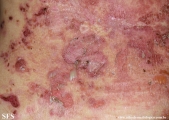 pemphigus foliaceus