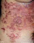 pemphigus foliaceus