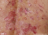 pemphigus foliaceus
