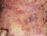 pemphigus foliaceus