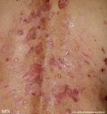 pemphigus foliaceus