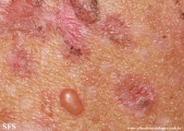 pemphigus foliaceus