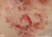 pemphigus foliaceus