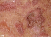 pemphigus foliaceus