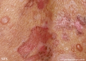 pemphigus foliaceus