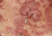 pemphigus foliaceus