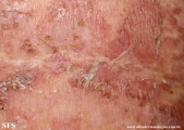 pemphigus foliaceus
