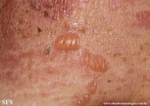 pemphigus foliaceus