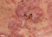 pemphigus foliaceus